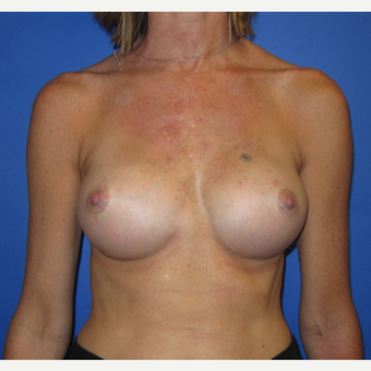 35-44 year old woman treated with Breast Augmentation (371cc) after 2844459
