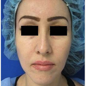Rhinoplasty before 2993771