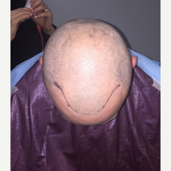 35-44 year old man treated with FUE Hair Transplant before 3109467