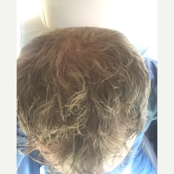 35-44 year old man treated with FUE Hair Transplant after 3109467