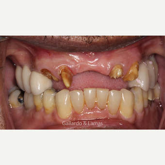 55-64 year old man treated with All-on-4 Dental Implants before 3258930