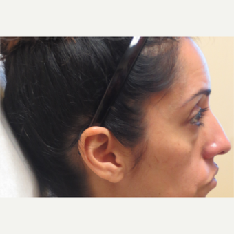 35-44 year old woman treated with Restylane under the eyes before 3381414