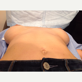25-34 year old woman treated with Breast Implants before 3075241
