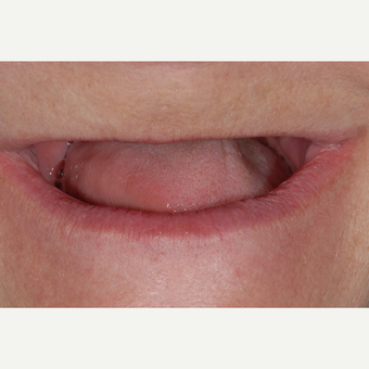 65-74 year old woman treated with All-on-4 Dental Implants before 3549503