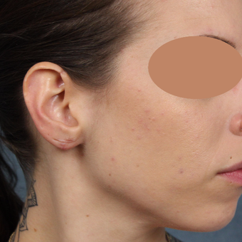 Gauge earlobe repair for extreme size gauges with earlobe lift and reconstruction after 3623497
