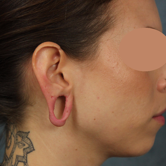 Gauge earlobe repair for extreme size gauges with earlobe lift and reconstruction before 3623497