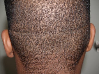 Hair Transplant - FUE 350 grafts before 253467