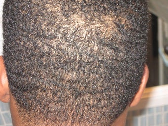 Hair Transplant - FUE 350 grafts after 253467
