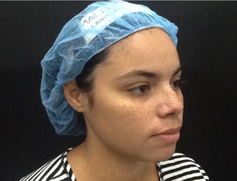 30 year old woman treated with Kybella. 2256048