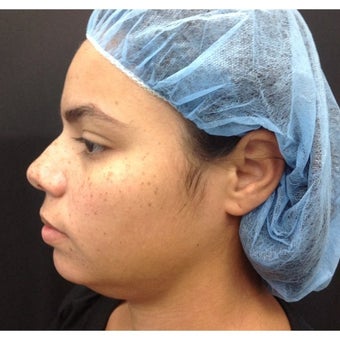 30 year old woman treated with Kybella. before 2256048