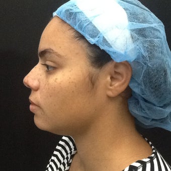 30 year old woman treated with Kybella. after 2256048