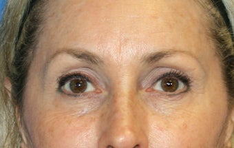 Browlift, Skin Pinch, and Fat Transfer before 1024367