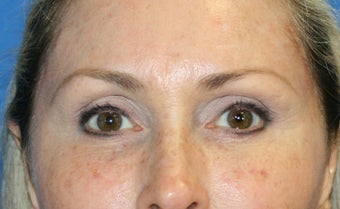 Browlift, Skin Pinch, and Fat Transfer after 1024367