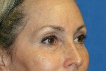 Browlift, Skin Pinch, and Fat Transfer 1024367