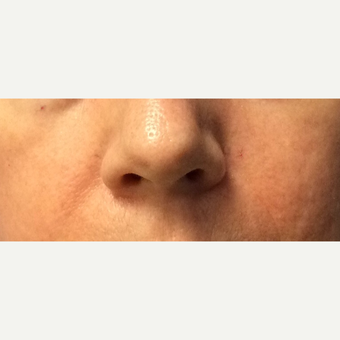 45-54 year old woman treated with Wrinkle Treatment after 3540106