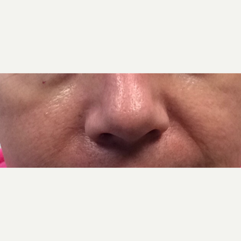 45-54 year old woman treated with Wrinkle Treatment before 3540106
