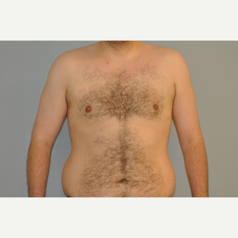 25-34 year old man treated with Male Breast Reduction after 3115266
