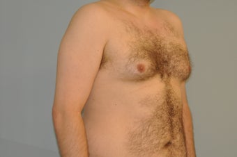 25-34 year old man treated with Male Breast Reduction 3115266