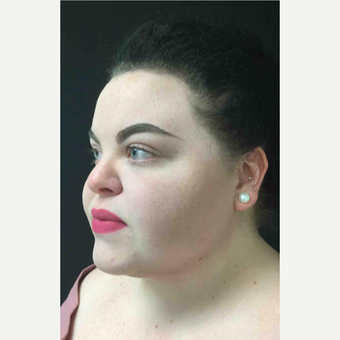 25-34 year old woman treated with Laser Liposuction to the Neck after 3200265