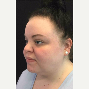 25-34 year old woman treated with Laser Liposuction to the Neck before 3200265