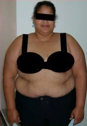 25 Year Old Female 124 pound weight loss before 1088774