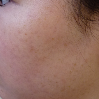 Acne and acne scar prevention after 3703833