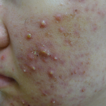 Acne and acne scar prevention before 3703833