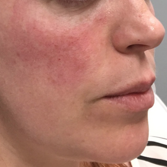 35-44 year old woman treated with Voluma after 3664759