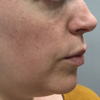 35-44 year old woman treated with Voluma before 3664759