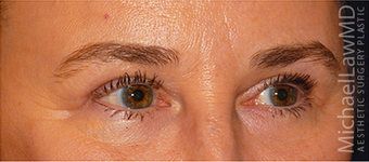 Eye Bag Surgery 887169