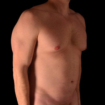 35-44 year old man treated with Vaser Liposuction before 1943516