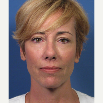 Non-surgical Lower Eyelid Rejuvenation after 3657157