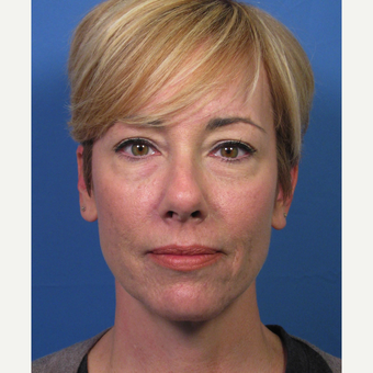 Non-surgical Lower Eyelid Rejuvenation before 3657157