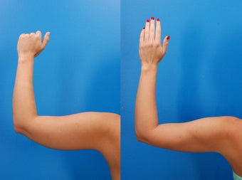 23 year old female before and after laser liposculpture of the arms before 1401982