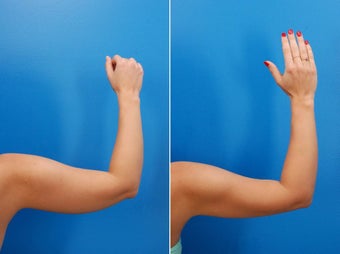 23 year old female before and after laser liposculpture of the arms after 1401982