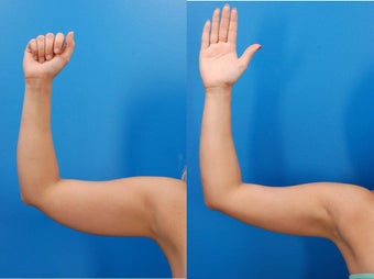 23 year old female before and after laser liposculpture of the arms 1401982