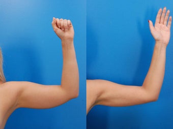 23 year old female before and after laser liposculpture of the arms 1401982