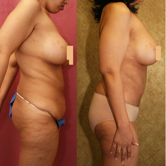 55-64 year old woman treated with Mommy Makeover after major weight loss after 3312109