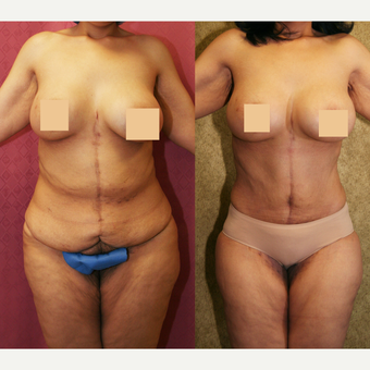 55-64 year old woman treated with Mommy Makeover after major weight loss before 3312109