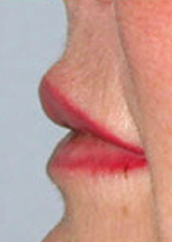 Lip Augmentation after 1072051