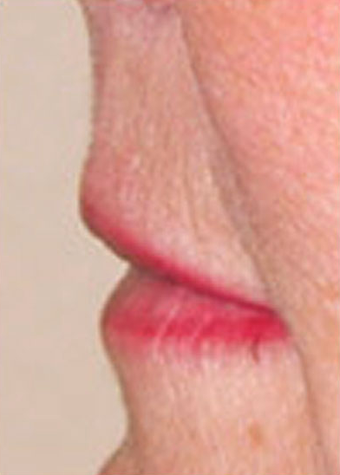 Lip Augmentation before 1072051
