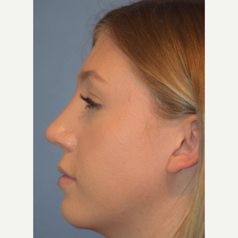17 or under year old woman treated with Rhinoplasty after 3441817