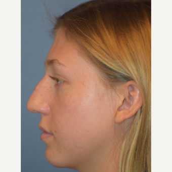 17 or under year old woman treated with Rhinoplasty before 3441817