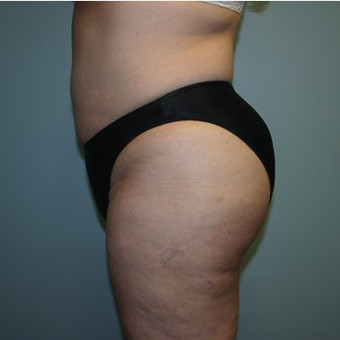 Brazilian Butt Lift after 3667583