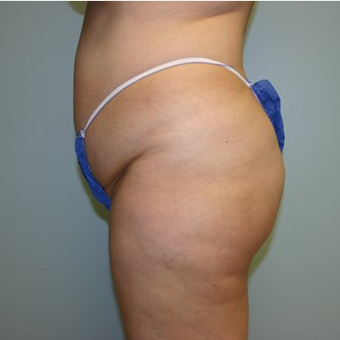 Brazilian Butt Lift before 3667583
