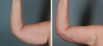 Arm Lift before 1382681