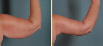 Arm Lift after 1382681