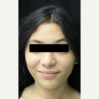 18-24 year old woman treated with Forehead Reduction after 3741765