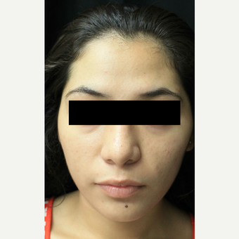 18-24 year old woman treated with Forehead Reduction before 3741765