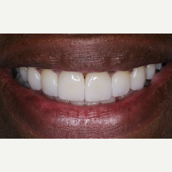 35-44 year old man treated with Porcelain Veneers after 3629777